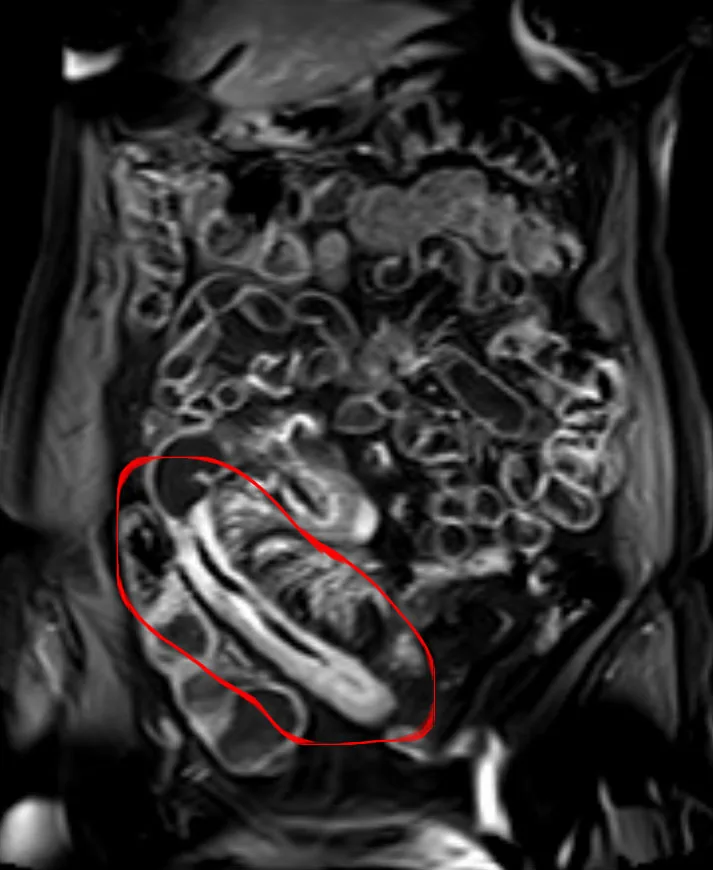 Crohn's disease – MRI scan: MR enteroclysis (contrast-enhanced T1, coronal): long segment of thickened, strongly enhancing terminal ileal wall (outlined)