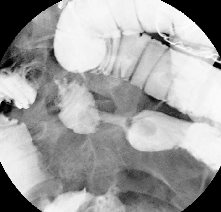 Crohn's disease – X-ray: Small-bowel double-contrast enteroclysis: fixed string-like small-bowel stricture with upstream dilatation