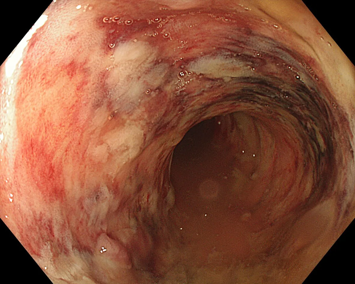 Ulcerative colitis – Colonoscopy: continuously inflamed mucosa with erythema, friability, fibrin-coated areas and confluent ulceration; vascular pattern lost
