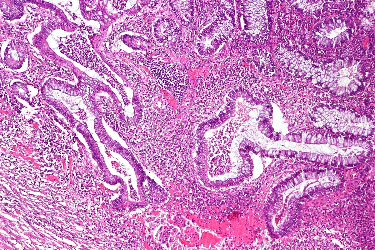 Ulcerative colitis – Histology (H&E) of chronic active ulcerative colitis: branched, irregular crypts and dense inflammatory infiltrate confined to the mucosa and superficial submucosa