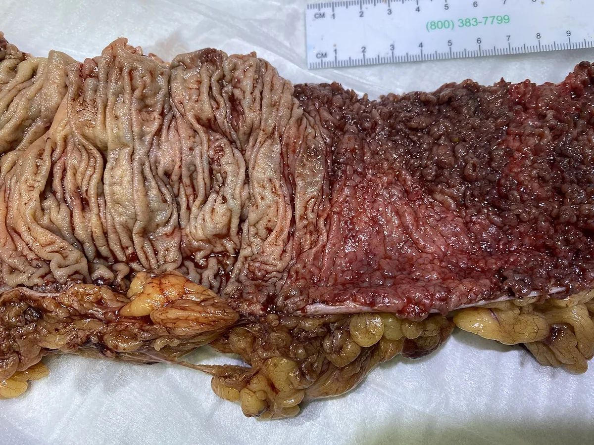 Ulcerative colitis – gross specimen: Opened colon: sharp border between normal mucosa (left) and severely inflamed mucosa with numerous small pseudopolyps (right)