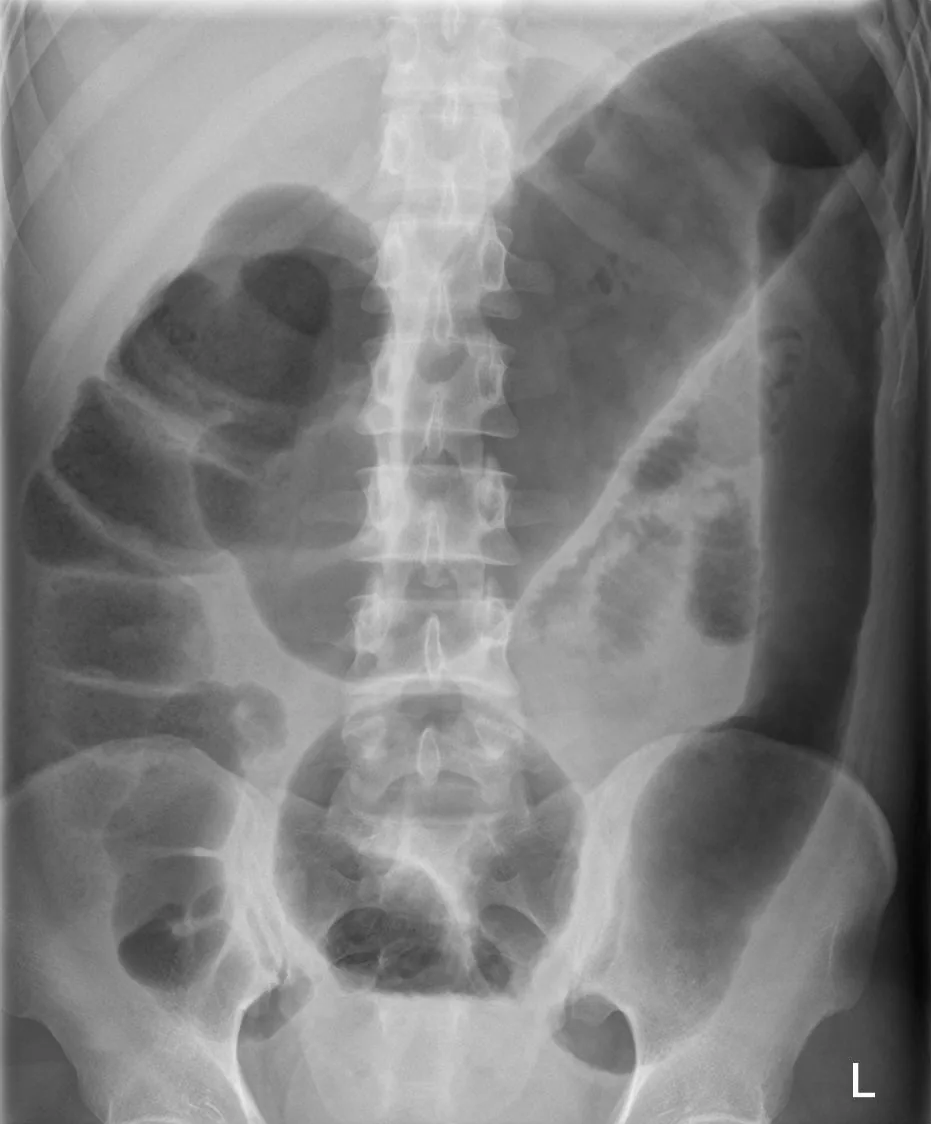 Ulcerative colitis – Plain abdominal X-ray in toxic megacolon: massively gas-distended colon with loss of haustration