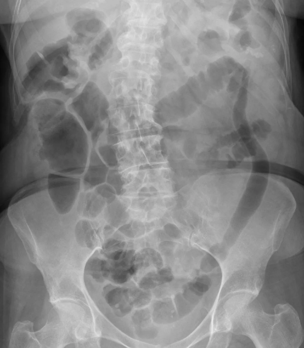 Ulcerative colitis – Plain abdominal X-ray: loss of haustra in the left colon, which appears as a smooth gas-filled tube ('lead-pipe' colon)