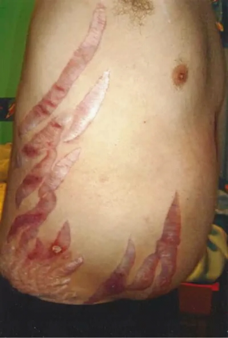 Cushing's syndrome – clinical photo: Striae rubrae in Cushing's syndrome: broad, red-violaceous stretch marks on the abdomen and flank