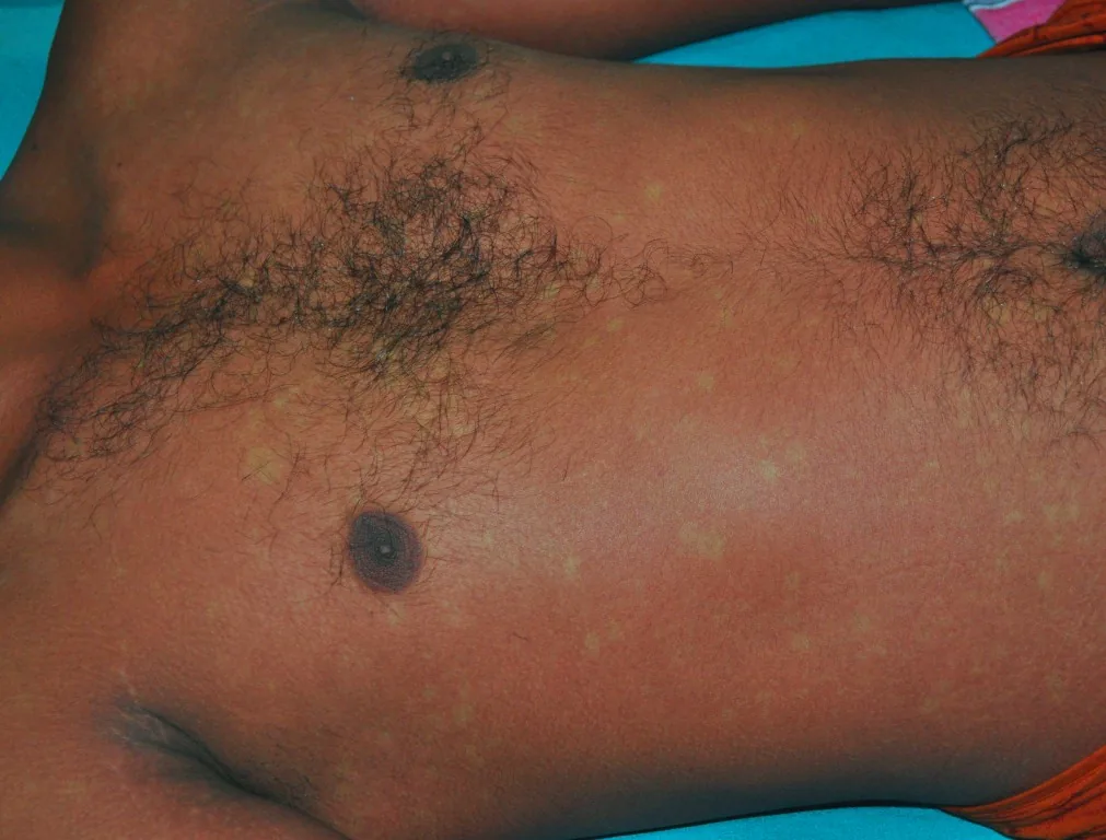 Dengue fever – clinical photo: Convalescent rash in dengue fever: confluent erythema with spared pale islands of skin ("white islands in a sea of red")