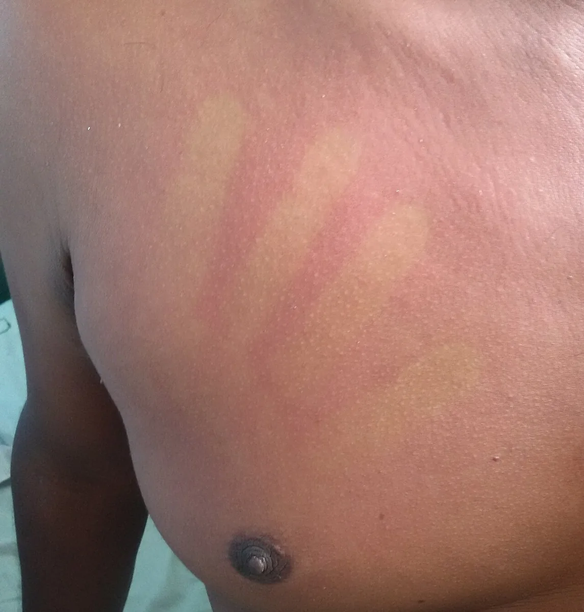 Dengue fever – clinical photo: Acute dengue fever: confluent, blanching erythema of the chest; finger marks remain pale after pressure