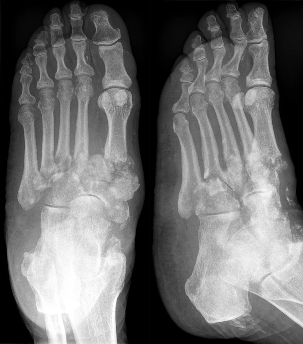 Diabetic foot syndrome – Foot X-ray in 2 planes: Charcot arthropathy with destruction and malalignment at the Lisfranc joint line