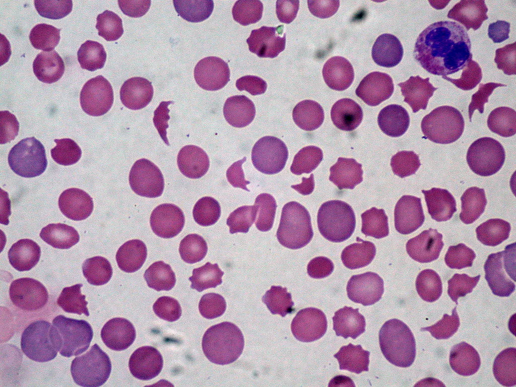 Disseminated intravascular coagulation (DIC) – Blood smear in DIC: numerous fragmented and spiculated red cells, almost no platelets (microangiopathic hemolysis)