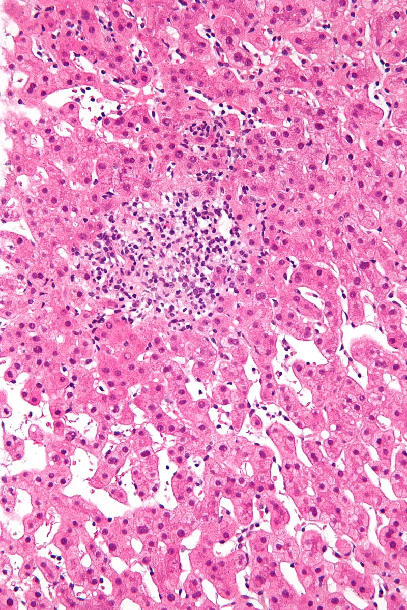 Drug-induced liver injury (DILI) – Histology (H&E): toxic hepatitis with a lobular inflammatory focus and a non-caseating granuloma