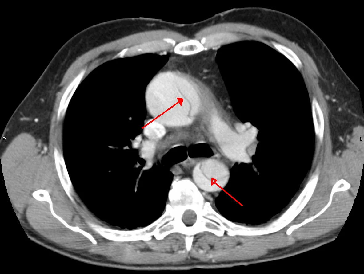 Aortic dissection – CT in Stanford type A dissection: intimal flap in both the ascending and the descending aorta (arrows)