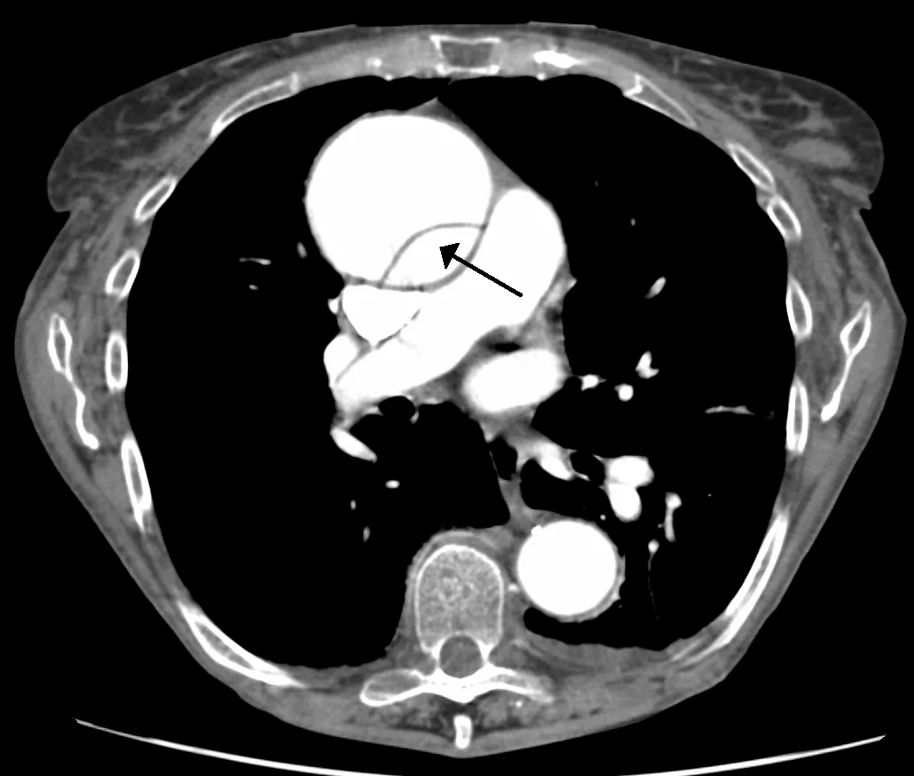 Aortic dissection – Contrast CT: thin intimal flap (arrow) dividing the dilated ascending aorta into true and false lumen