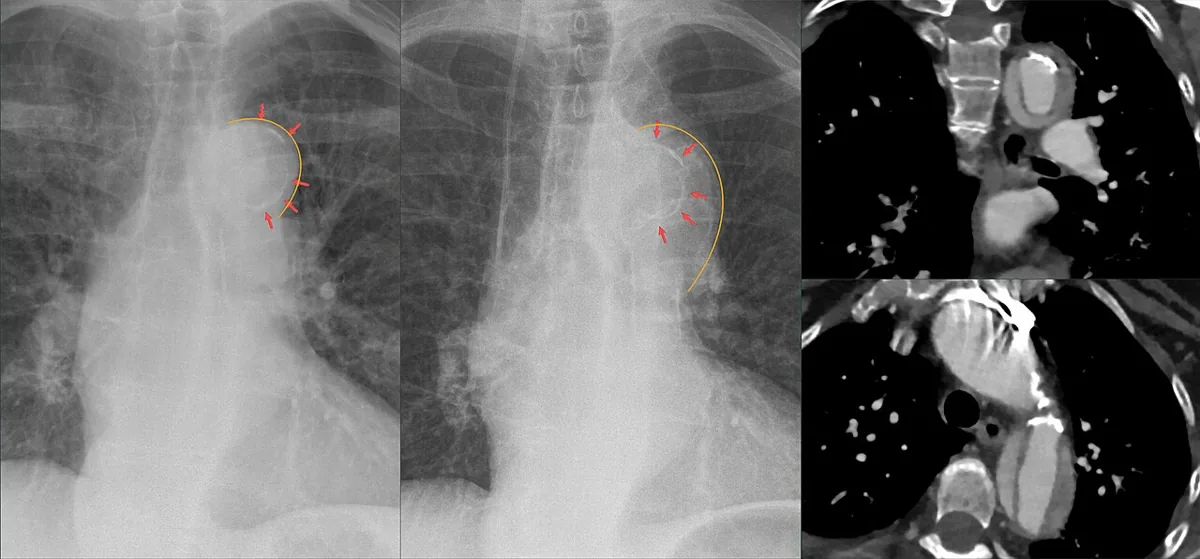 Aortic dissection – Chest X-ray before/after and CT: widened aortic arch with inwardly displaced intimal calcification (arrows); CT shows the dissection in the arch