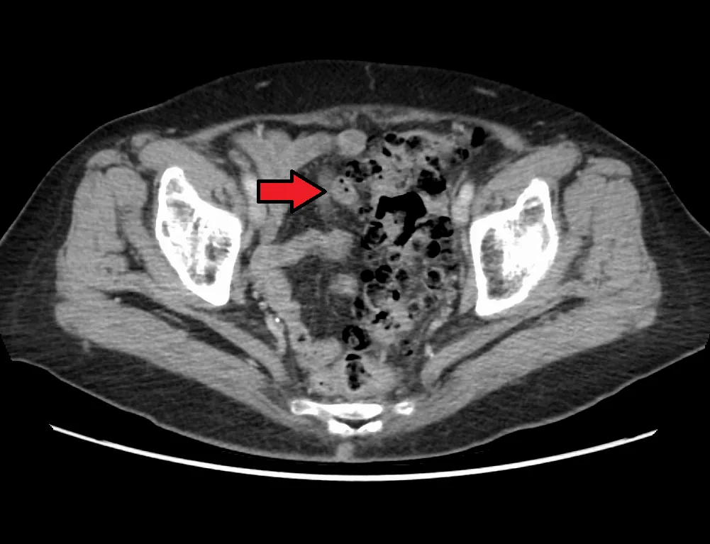 Diverticular disease and diverticulitis – Pelvic CT: sigmoid colon with numerous gas-filled diverticula, thickened wall and inflammatory fat stranding (arrow)