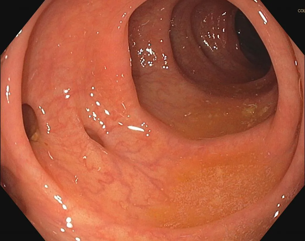 Diverticular disease and diverticulitis – Colonoscopy: two diverticular openings in otherwise normal colonic mucosa (diverticulosis)