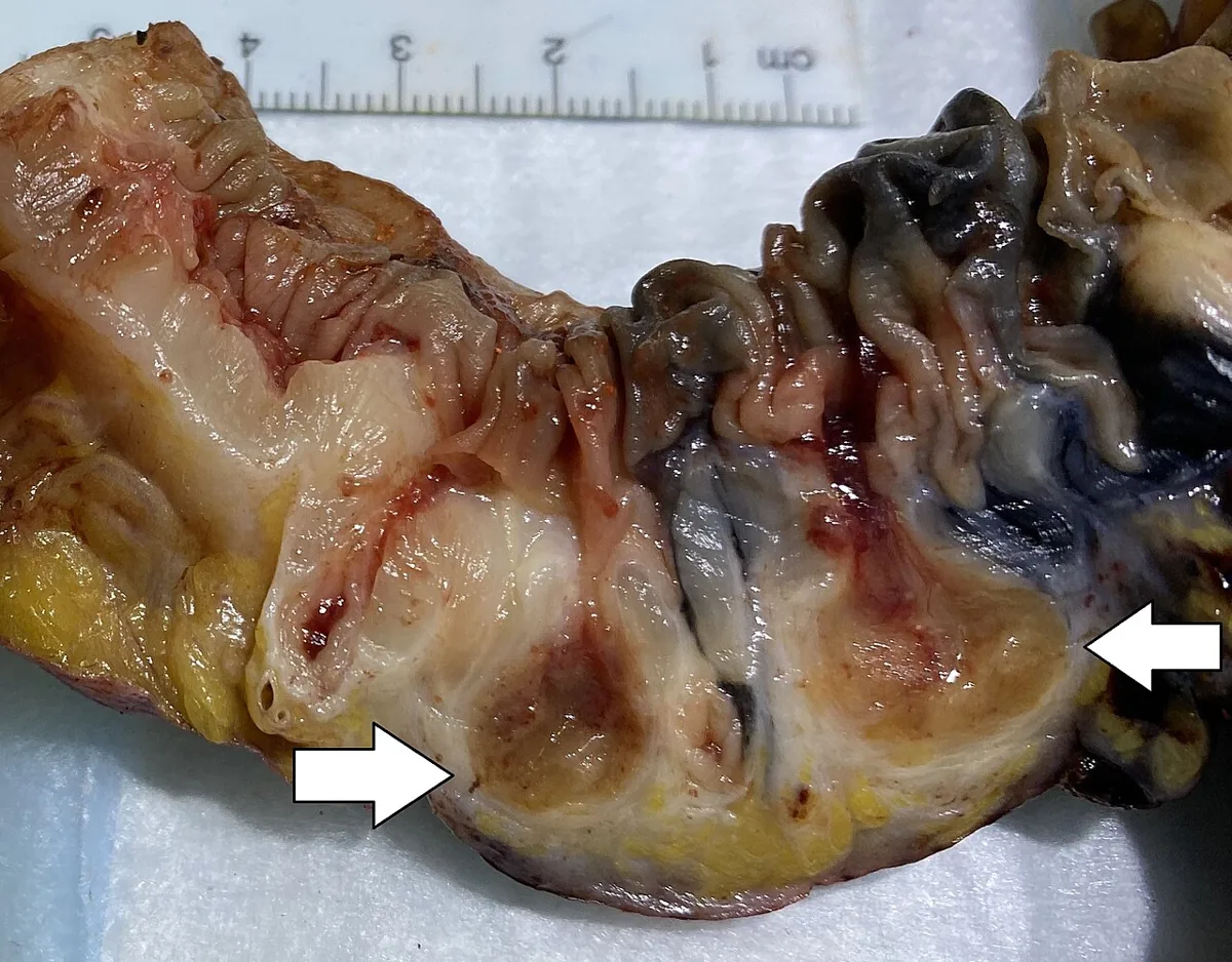 Diverticular disease and diverticulitis – gross specimen: Longitudinally opened colon: diverticulitis with two diverticular abscesses in the bowel wall (white arrows)