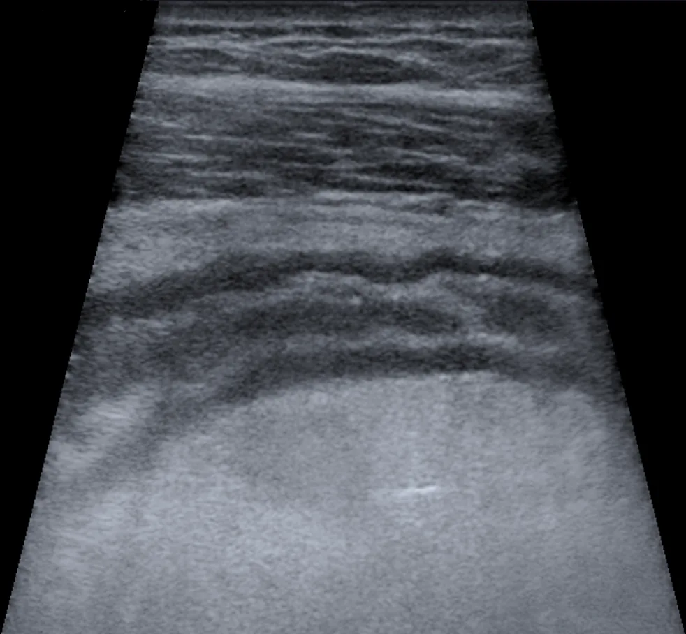 Diverticular disease and diverticulitis – Ultrasound, longitudinal view: inflammatory thickening of the sigmoid wall in sigmoid diverticulitis