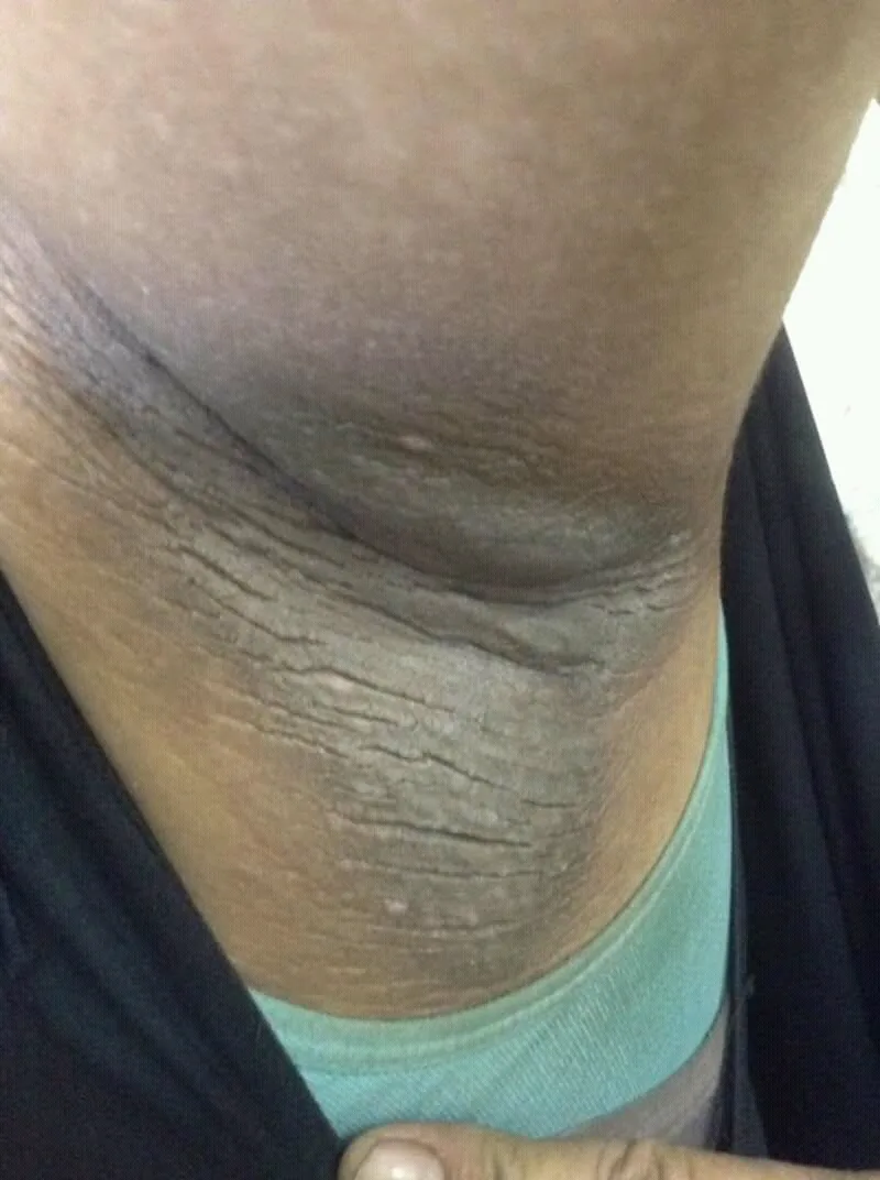 Diabetes mellitus Typ 2 (Zuckerkrankheit) – klinisches Foto: Acanthosis nigricans am Hals: samtartig verdickte, bräunlich-dunkle Haut in den Falten als Zeichen der Insulinresistenz