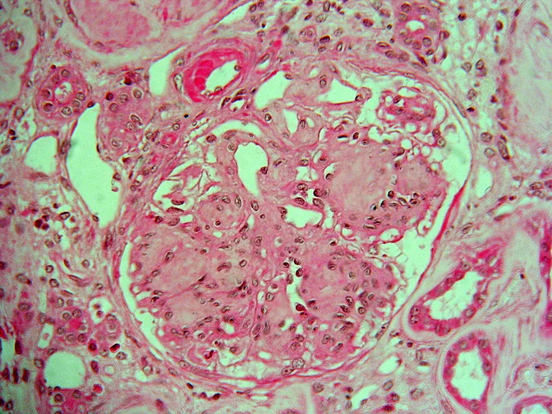 Diabetic kidney disease – Histology in diabetic nephropathy: glomerulus with nodular mesangial expansion (Kimmelstiel–Wilson nodules)