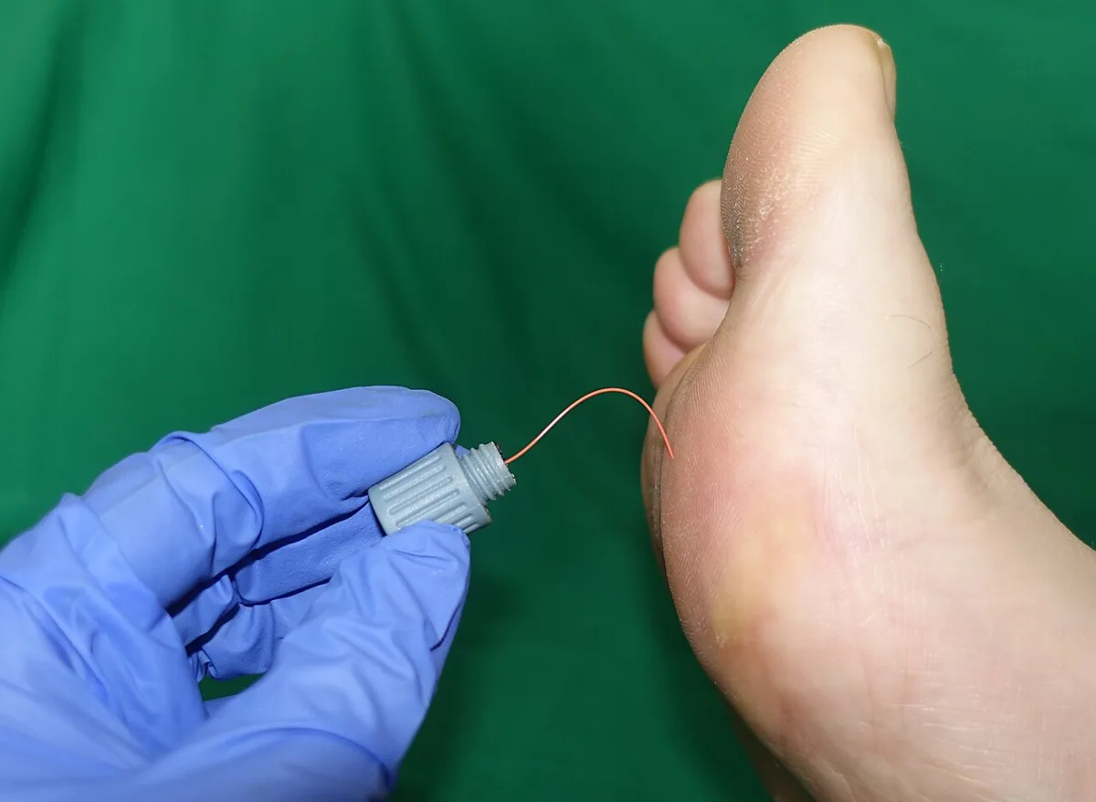 Diabetic polyneuropathy – clinical photo: Testing pressure sensation on the sole of the foot with the 10 g monofilament