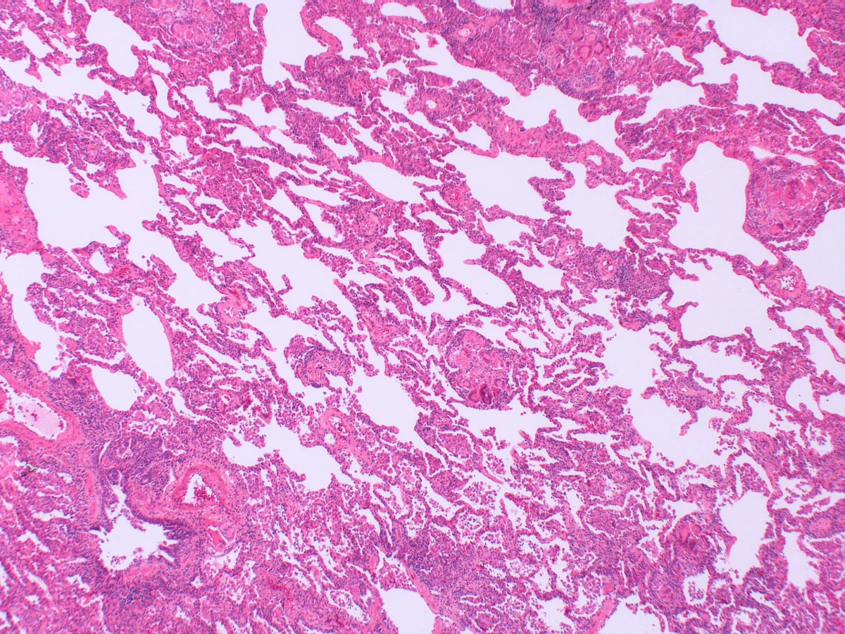 Hypersensitivity pneumonitis – Histology (H&E): hypersensitivity pneumonitis with lymphocytic interstitial inflammation and several small, loosely formed granulomas