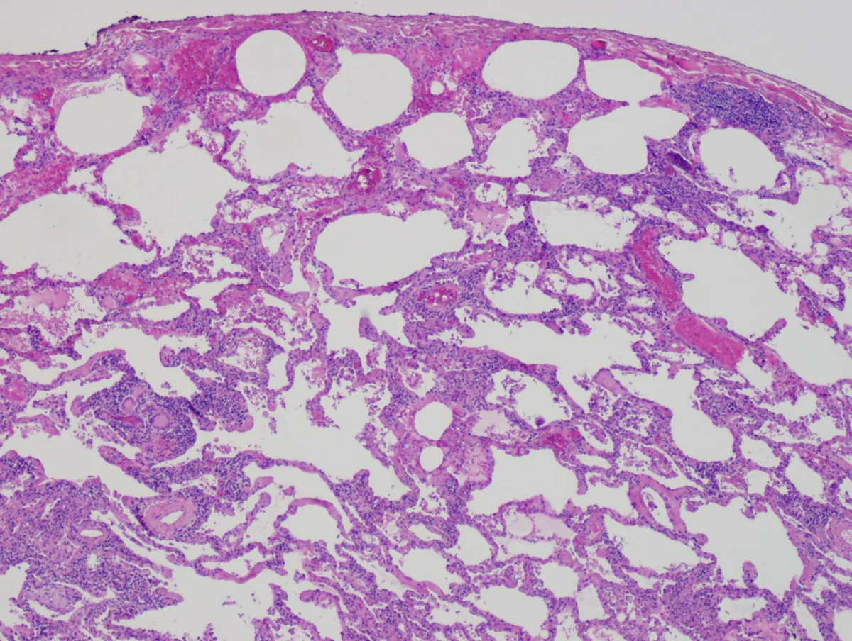 Hypersensitivity pneumonitis – Histology (H&E): chronic hypersensitivity pneumonitis – interstitium widened by a chronic inflammatory infiltrate with scattered multinucleated giant cells