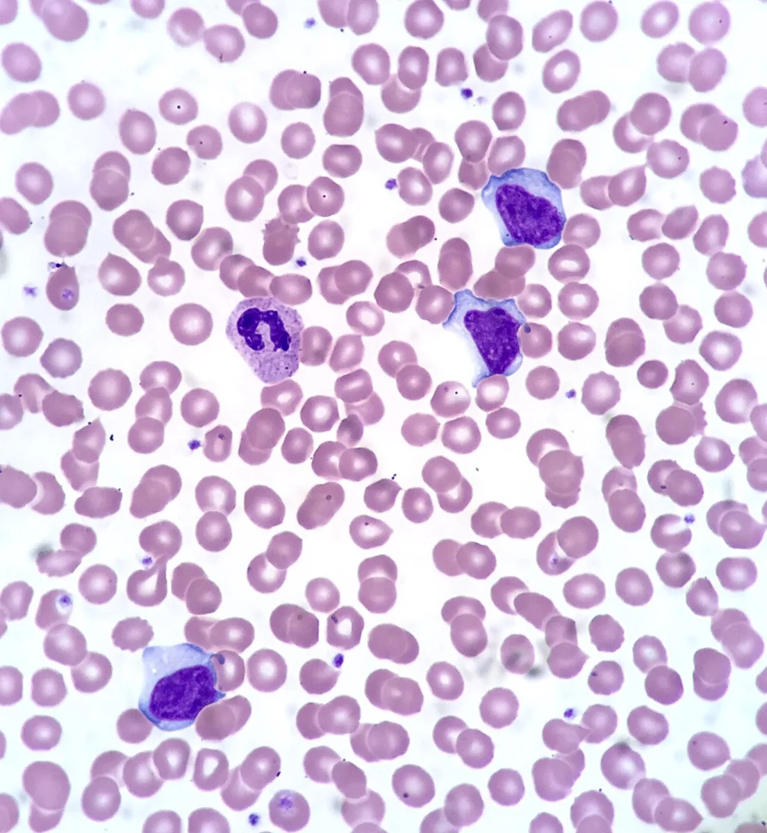 Infectious mononucleosis (glandular fever) – Blood smear in infectious mononucleosis: three large reactive lymphocytes (Downey cells) with abundant cytoplasm and a basophilic rim