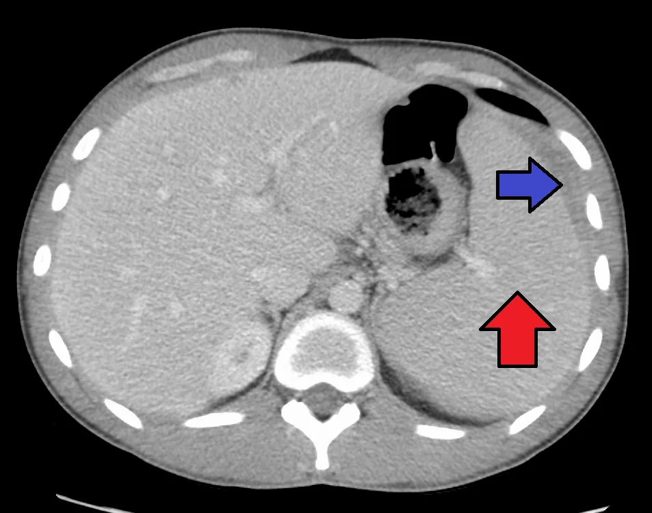 Infectious mononucleosis (glandular fever) – CT in mononucleosis: enlarged spleen (red arrow) with a subcapsular hematoma (blue arrow)