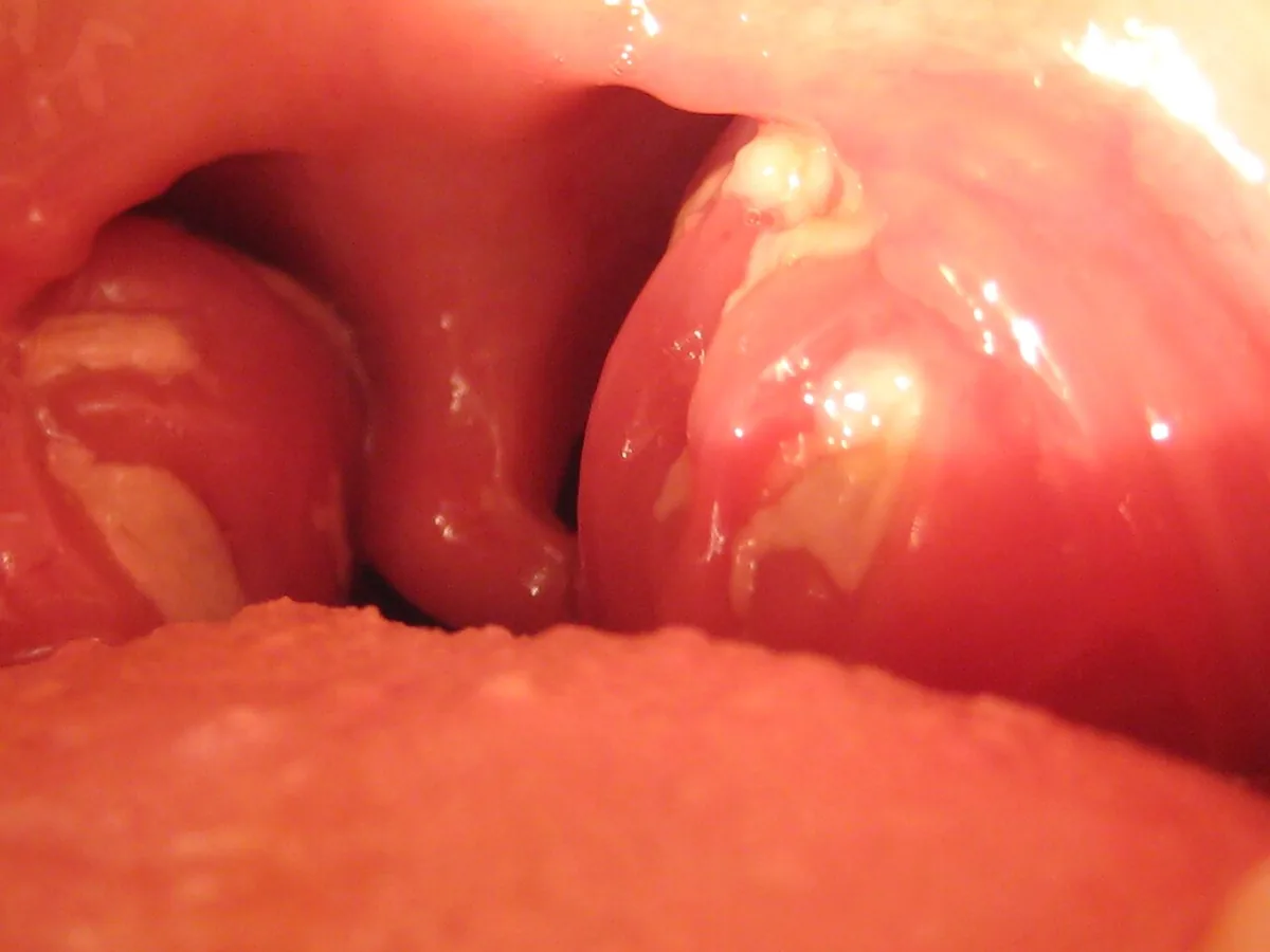 Infectious mononucleosis (glandular fever) – clinical photo: Mononucleosis tonsillitis: markedly swollen palatine tonsils with whitish-yellow exudate