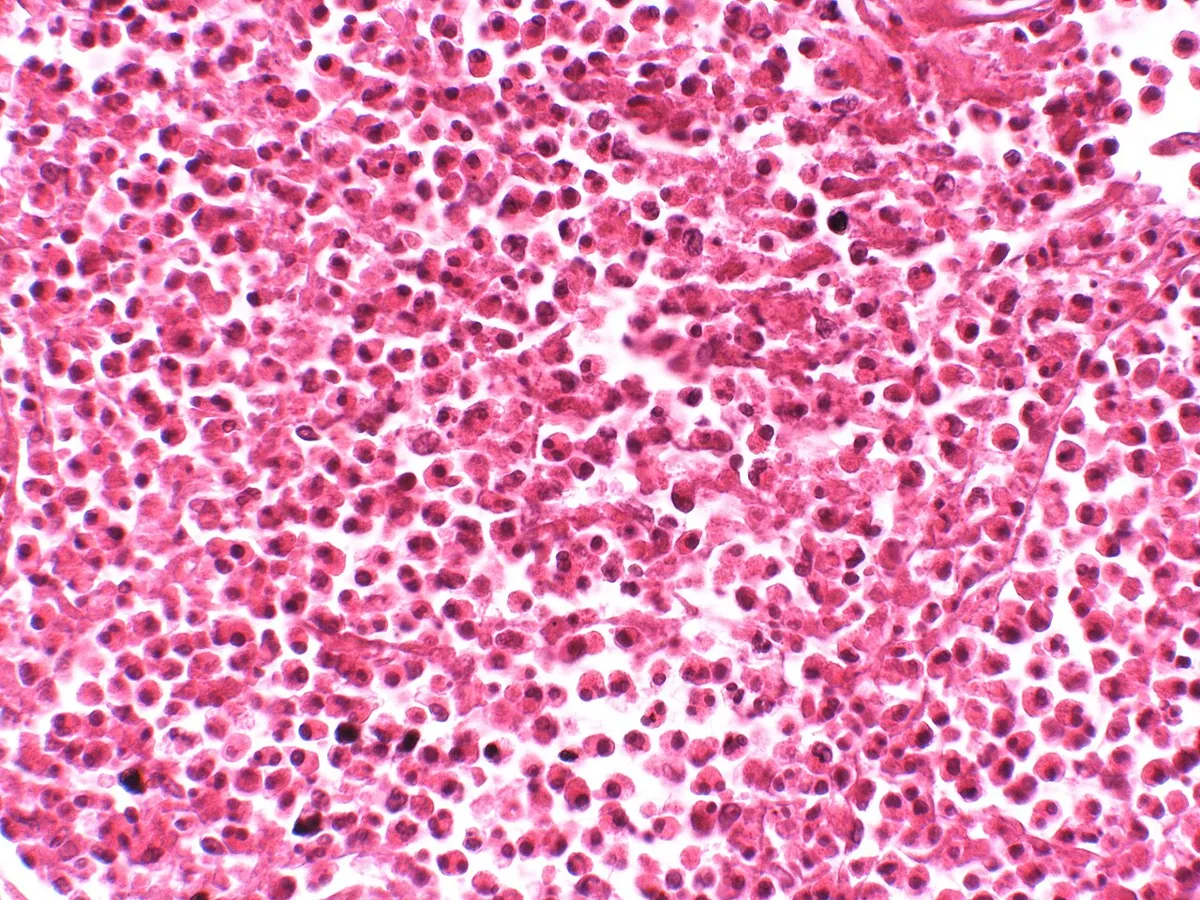 Eosinophile Granulomatose mit Polyangiitis (EGPA, Churg-Strauss) – Histologie (HE), starke Vergrößerung: dichtes gemischtes Infiltrat mit zahlreichen eosinophilen Granulozyten neben einem nekrotischen Gefäß