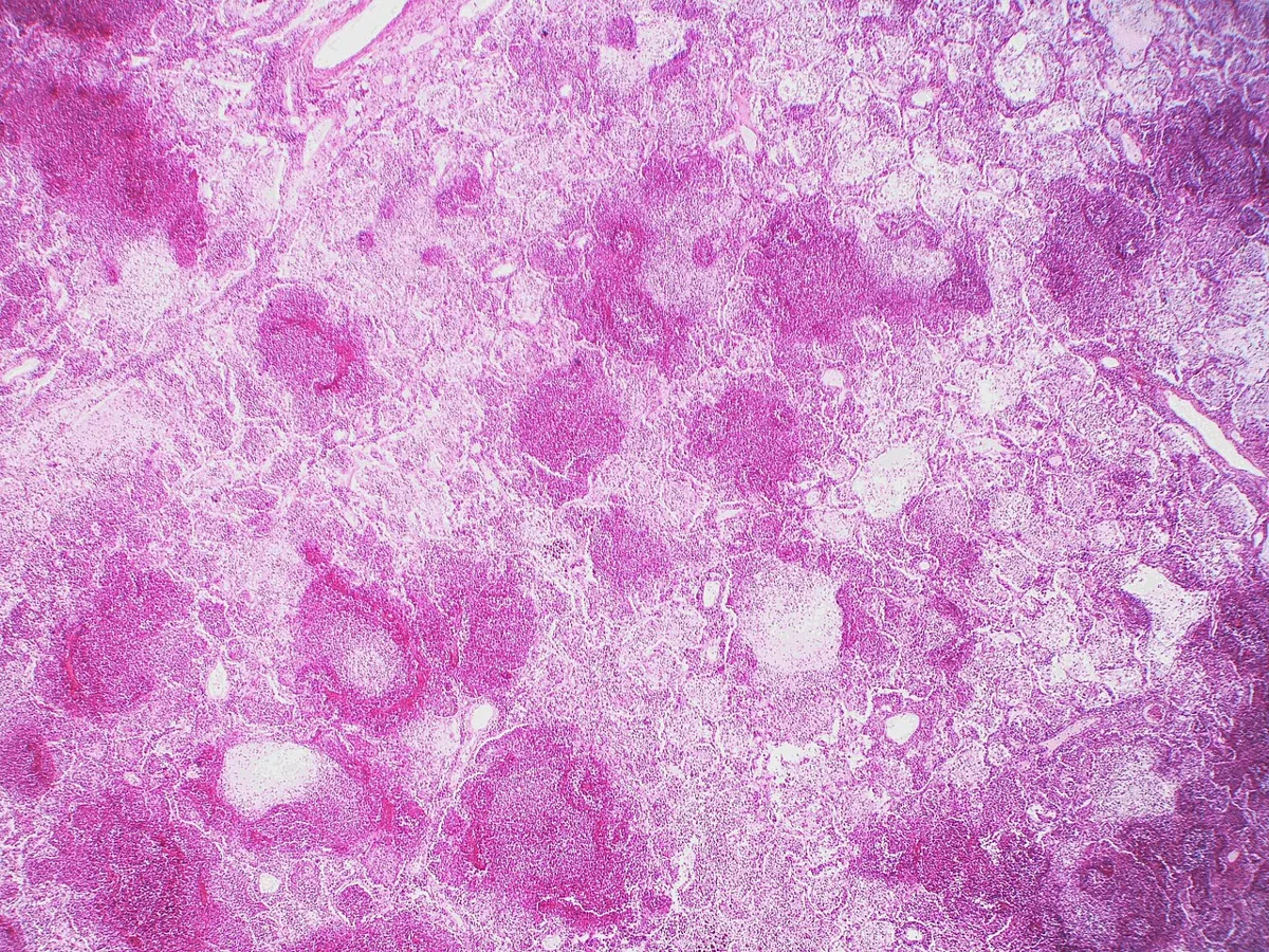 Eosinophile Granulomatose mit Polyangiitis (EGPA, Churg-Strauss) – Histologie (HE), Übersicht: mehrere umschriebene Herde nekrotisierender Vaskulitis mit umgebendem Entzündungsinfiltrat
