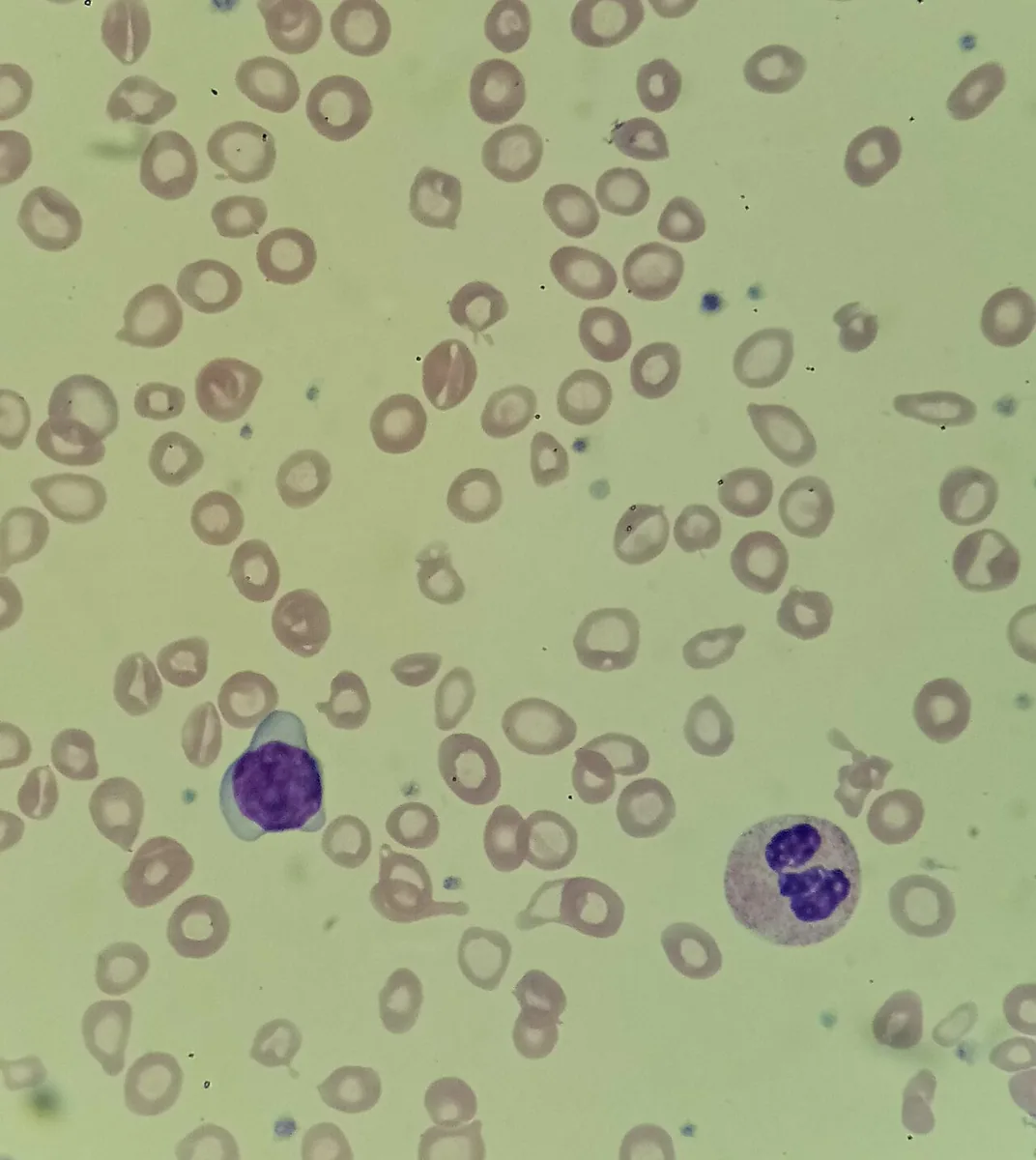 Iron deficiency anemia – Blood smear in severe iron deficiency: marked microcytosis and hypochromia with thin hemoglobin rims, pencil cells and poikilocytes