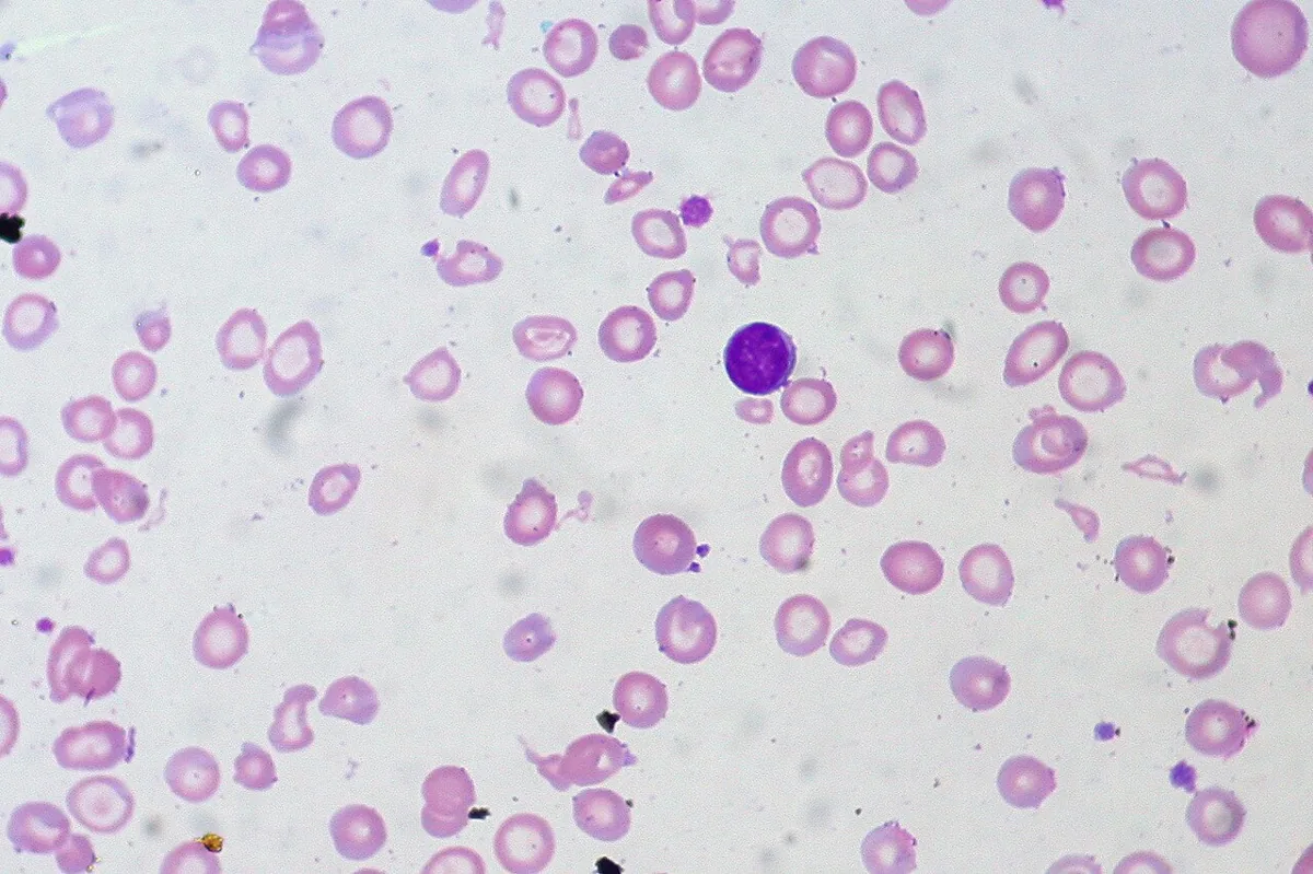 Iron deficiency anemia – Blood smear: small, pale (hypochromic, microcytic) red cells with enlarged central pallor and occasional pencil cells