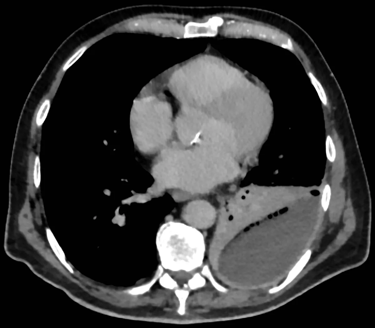 Pleural empyema – Contrast-enhanced axial CT: loculated left pleural collection with gas bubbles and adjacent consolidated lung (pleural empyema)