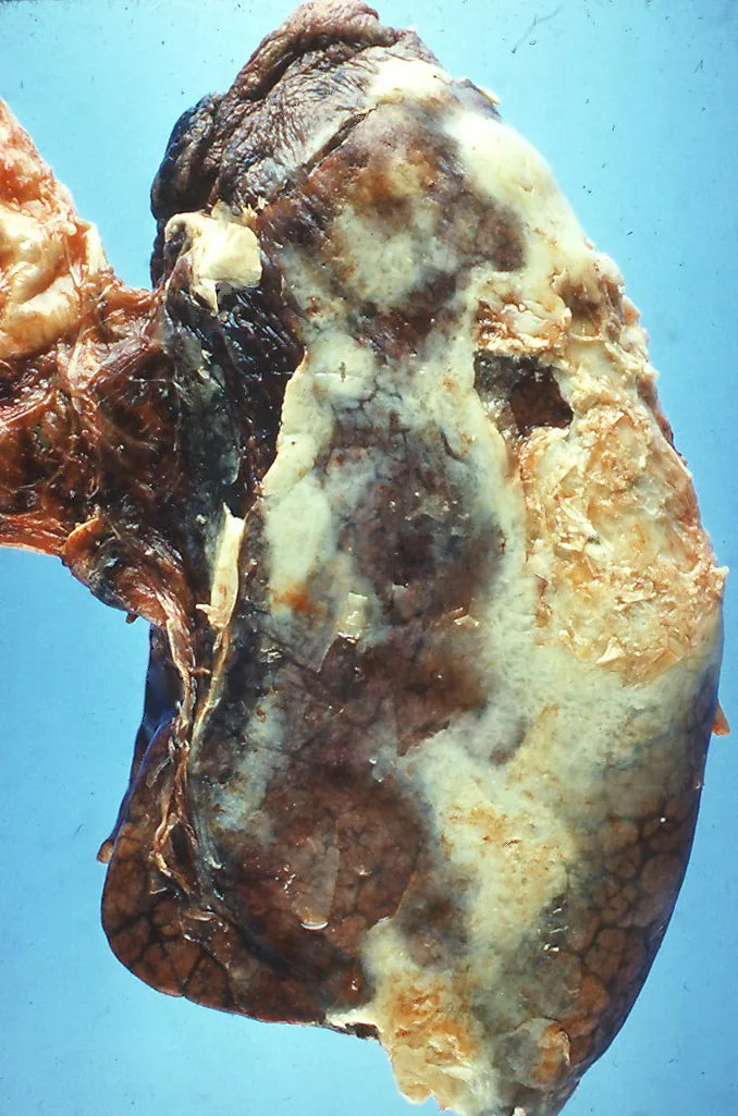Pleural empyema – Gross specimen: lung covered by thick yellowish purulent deposits on the pleural surface (pleural empyema)