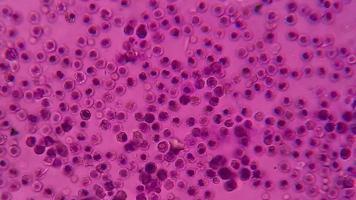 Pleural empyema – Wet mount of pleural fluid (methylene blue): abundant pus cells (neutrophils) and red blood cells