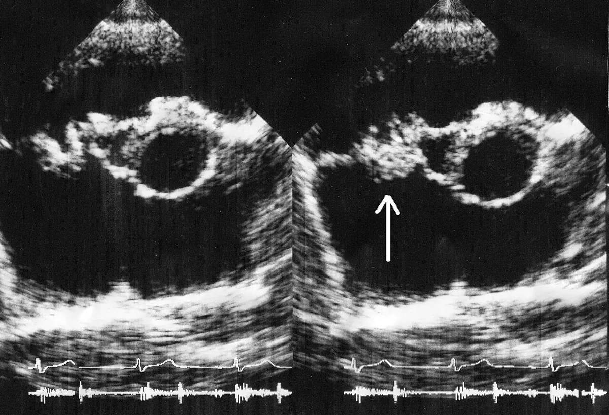 Infective endocarditis – Echocardiogram (parasternal short axis): echogenic vegetation on the tricuspid valve (arrow)