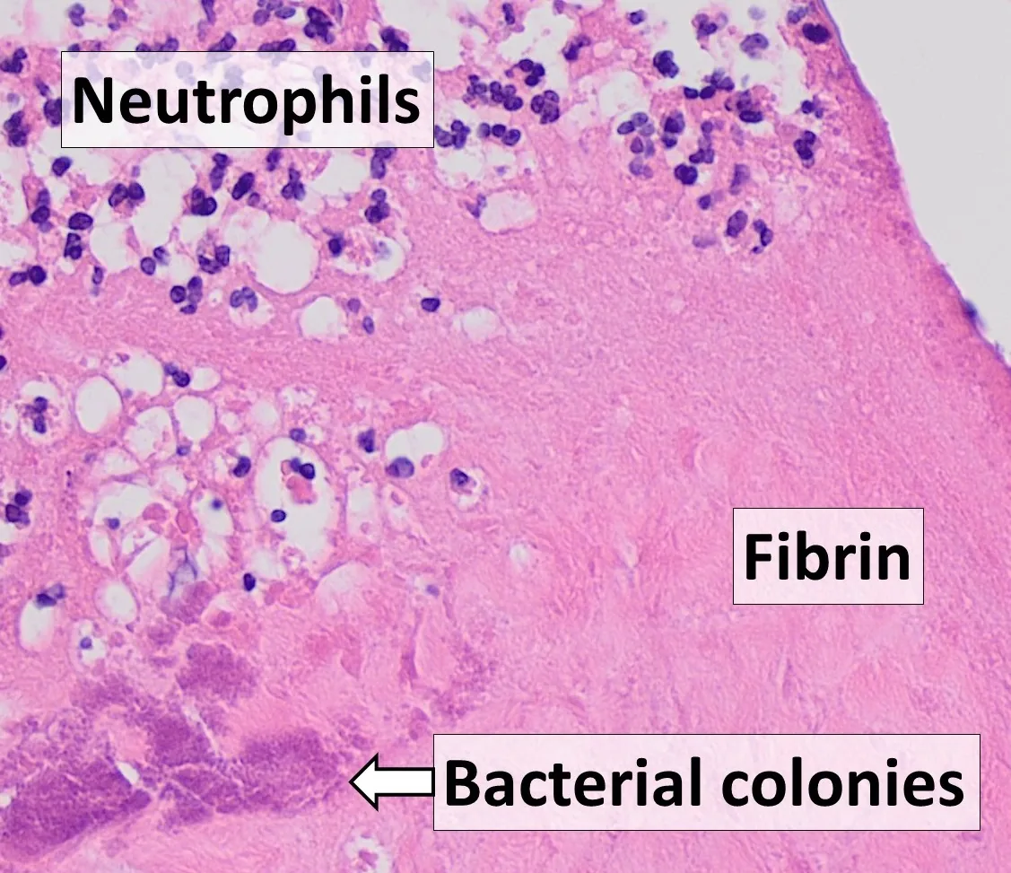 Infective endocarditis – Histology of a valve vegetation (H&E): fibrin, neutrophils and bacterial colonies (labelled)
