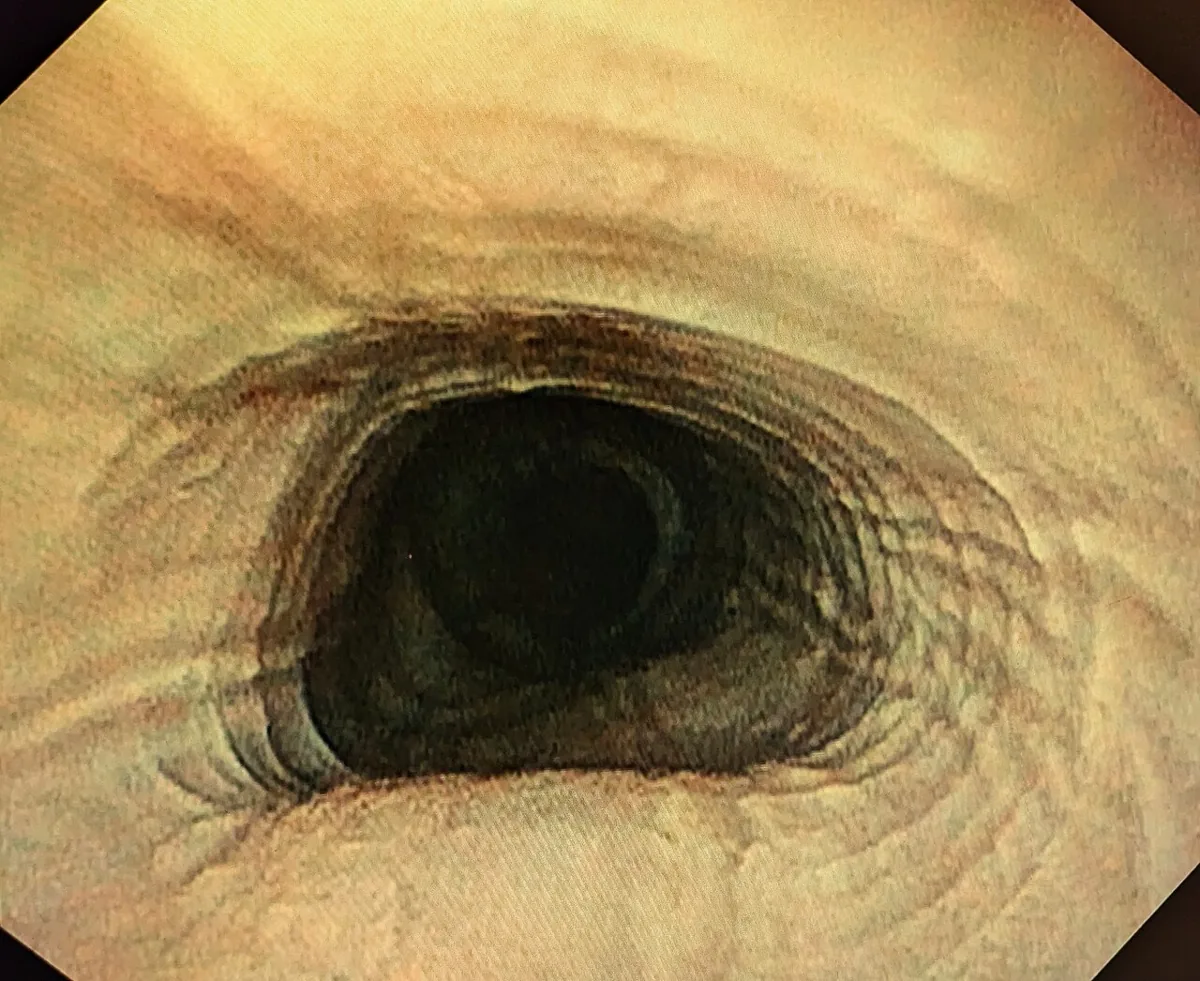 Eosinophilic esophagitis – Endoscopy: circular rings ('trachealisation') and longitudinal furrows of the esophageal mucosa