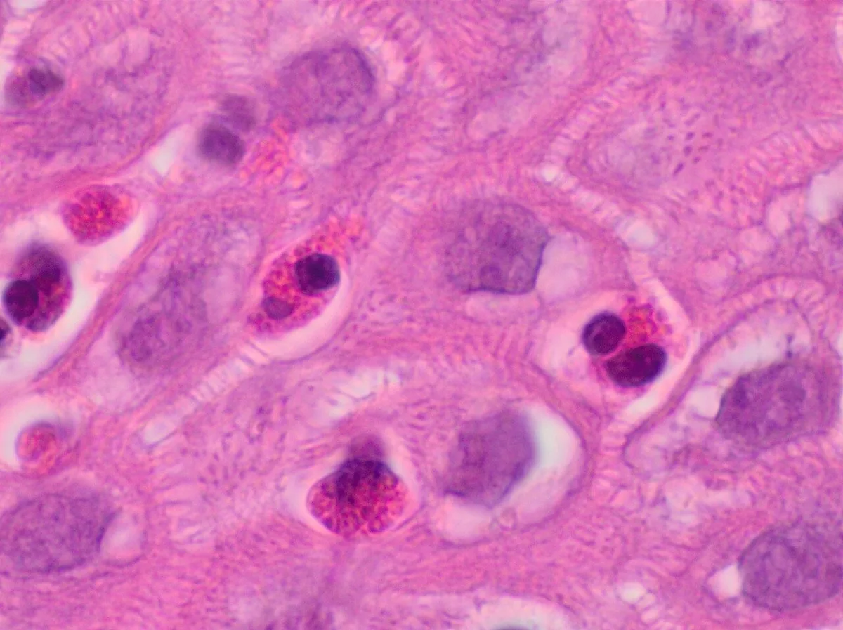 Eosinophilic esophagitis – Histology (H&E): numerous eosinophils within the esophageal squamous epithelium with intercellular edema
