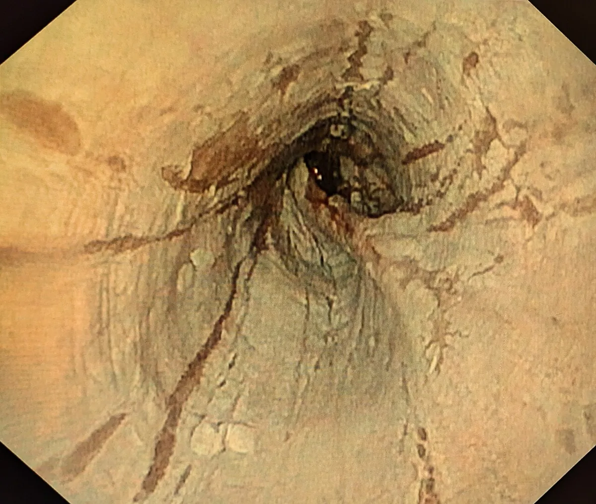 Eosinophilic esophagitis – Endoscopy: fragile 'crepe-paper' mucosa with fine longitudinal tears