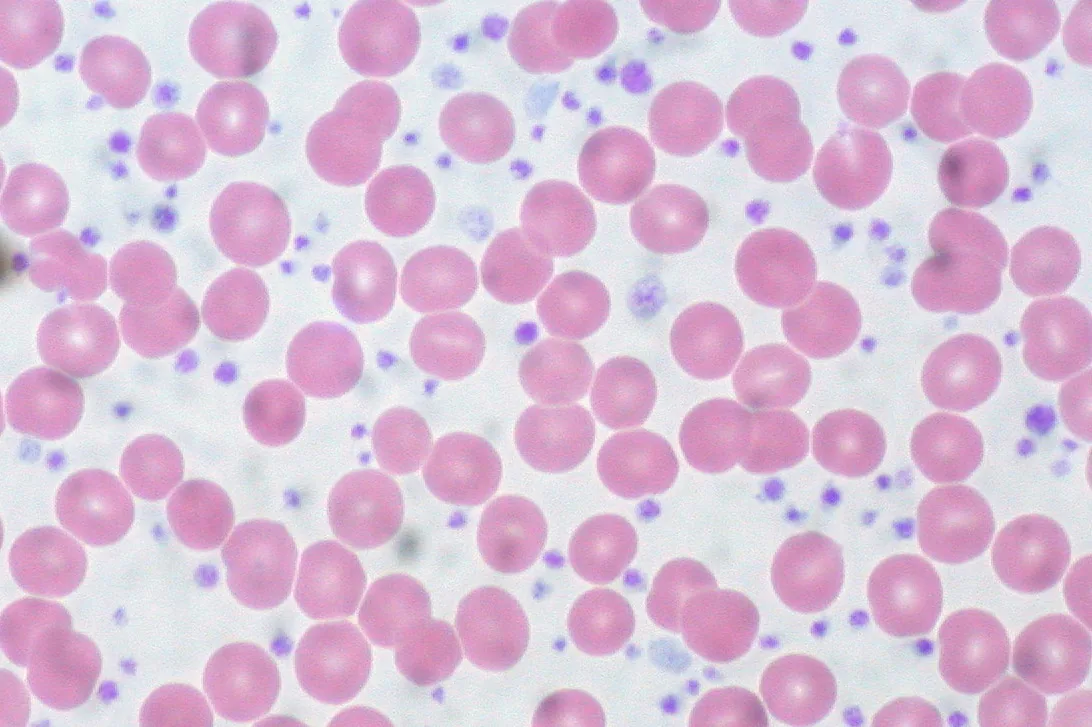 Essential thrombocythemia – Blood smear in essential thrombocythemia: masses of platelets (about 1.5–2 million/µl), some large, between the red cells