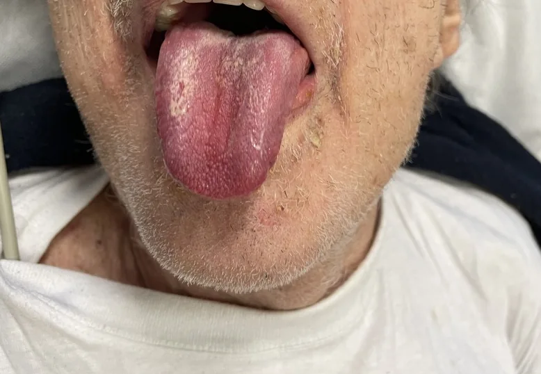 Dehydration – mouth – clinical photo: Dry tongue in dehydration: dry, cracked, coated tongue surface and dry lips