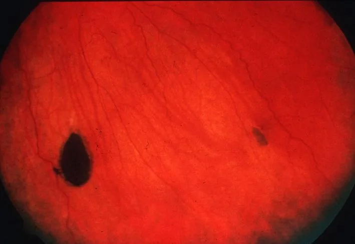 Familial adenomatous polyposis (FAP) – Fundus: sharply demarcated dark pigmented spots (congenital hypertrophy of the retinal pigment epithelium, CHRPE)