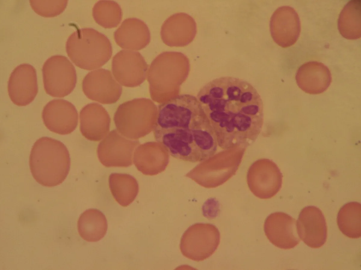 Folate deficiency – Blood smear: hypersegmented neutrophil with many nuclear lobes beside large red cells (megaloblastic picture)