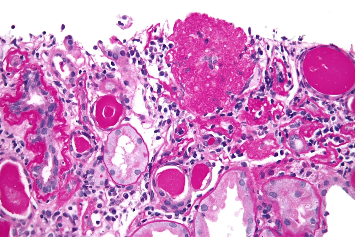 Focal segmental glomerulosclerosis (FSGS) – Histology of the collapsing variant: collapsed capillary tuft with hypertrophic podocytes, protein casts nearby