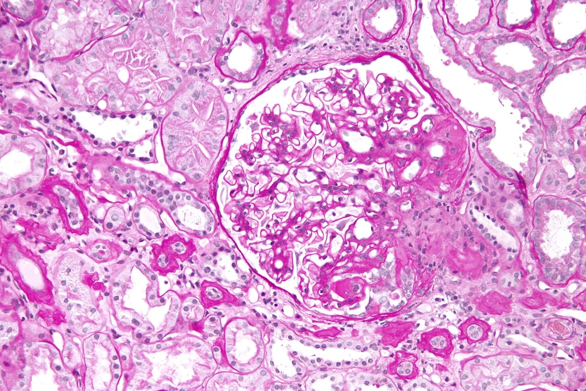 Focal segmental glomerulosclerosis (FSGS) – Histology (PAS) in FSGS: glomerulus with sclerosis confined to one segment of the capillary tuft