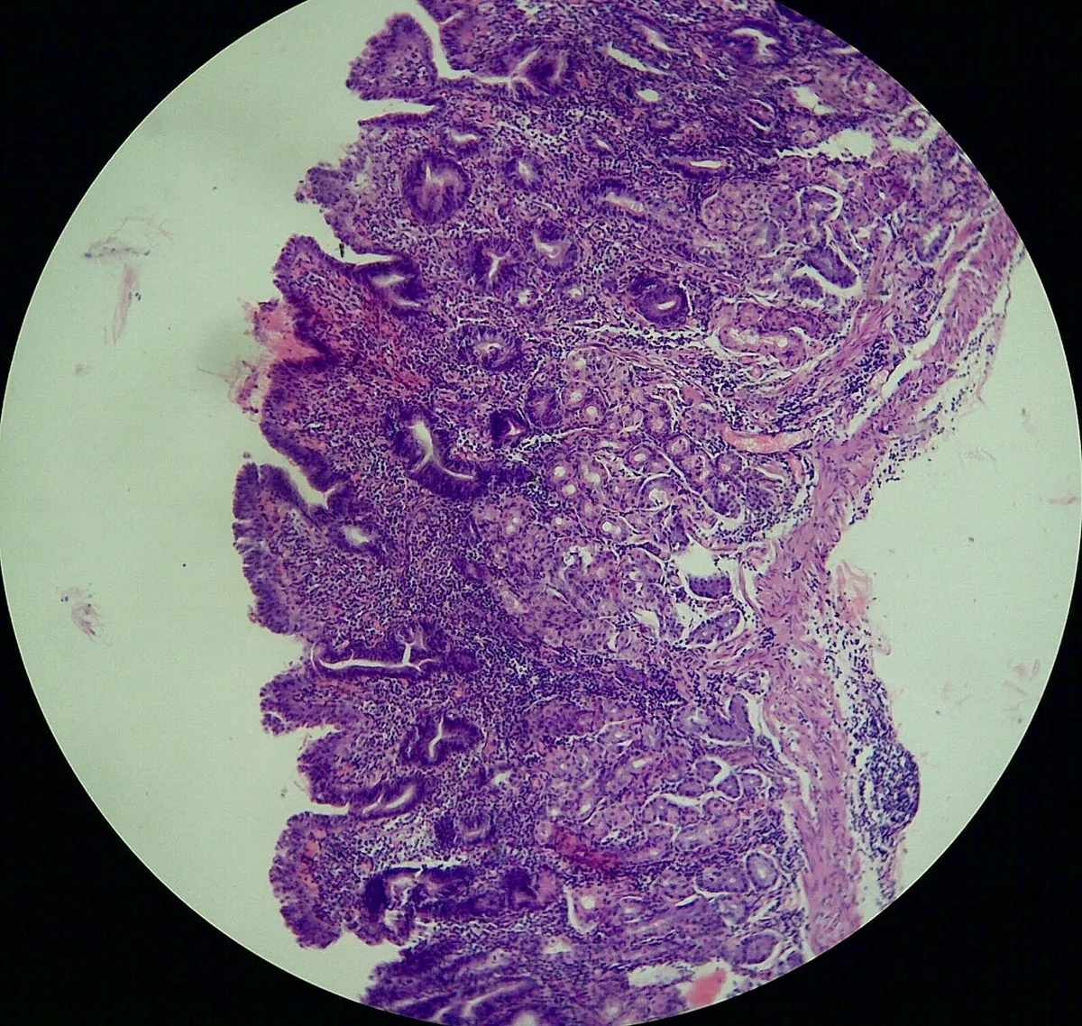 Gastritis (type A, B and C) – Histology (H&E) of atrophic gastritis: reduced glands and inflammatory infiltrate of the mucosa