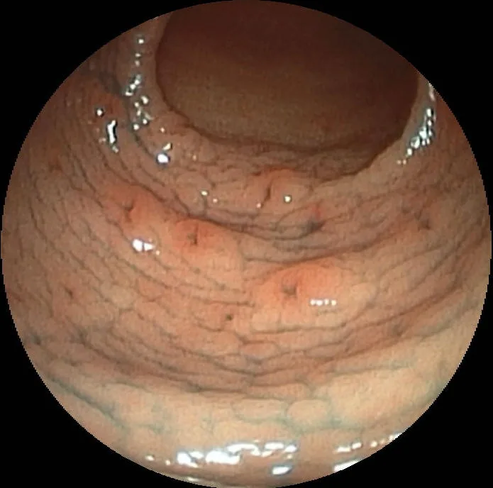 Gastritis (type A, B and C) – endoscopy: Gastroscopy: several small erosions with a red rim in the antrum (erosive gastritis)