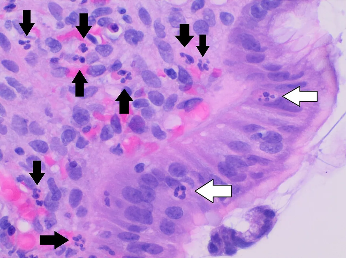Gastritis (type A, B and C) – Histology (H&E, labelled) of active gastritis: neutrophils within the epithelium (white arrows) and in the lamina propria (black arrows)