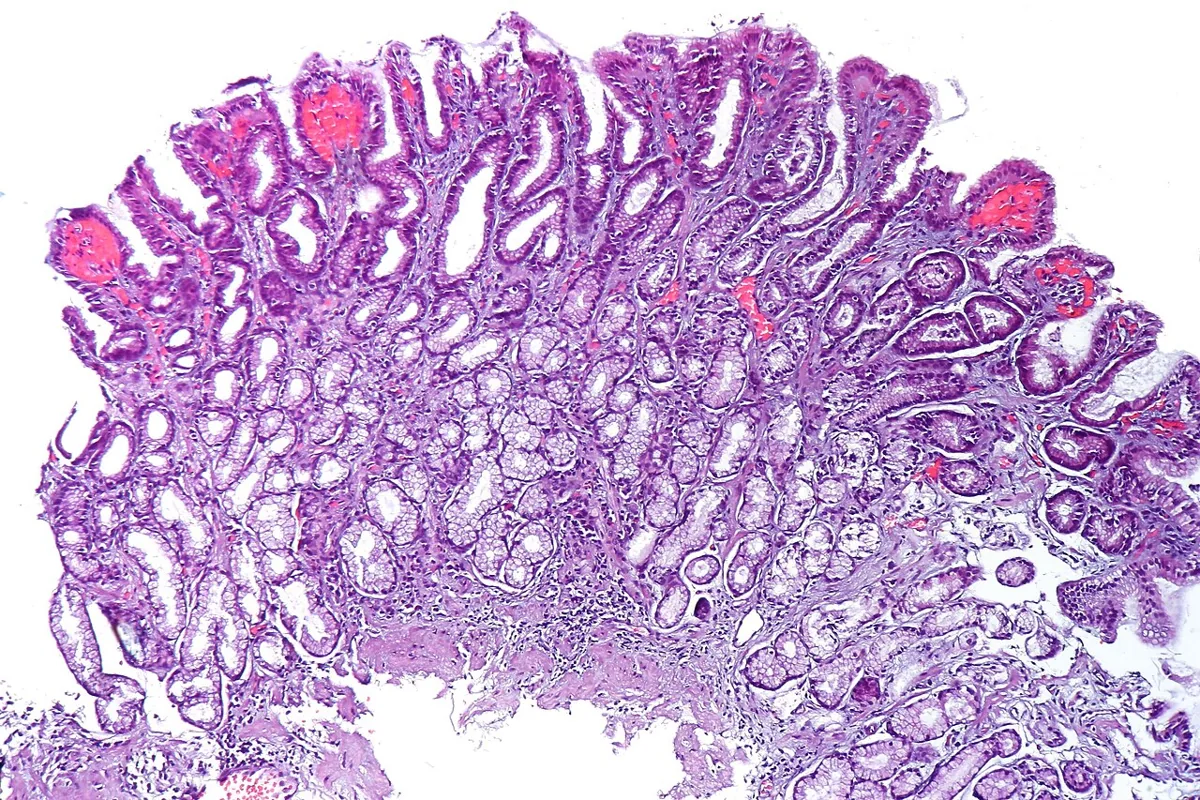 Gastritis (type A, B and C) – Histology (H&E) of reactive (chemical) gastropathy: tortuous foveolae, vascular congestion, few inflammatory cells